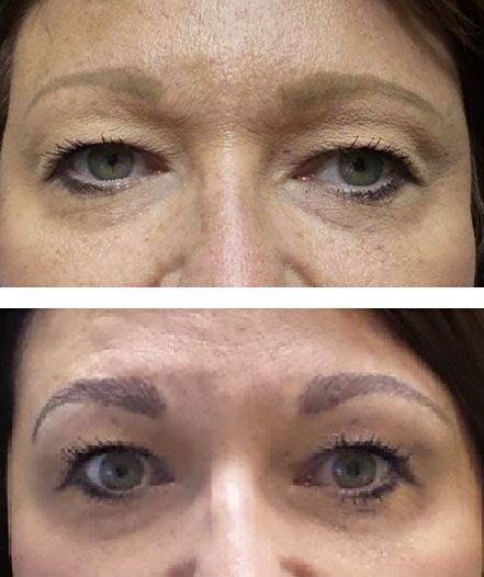 Permanent eyebrows reshaped and recolored with microblading