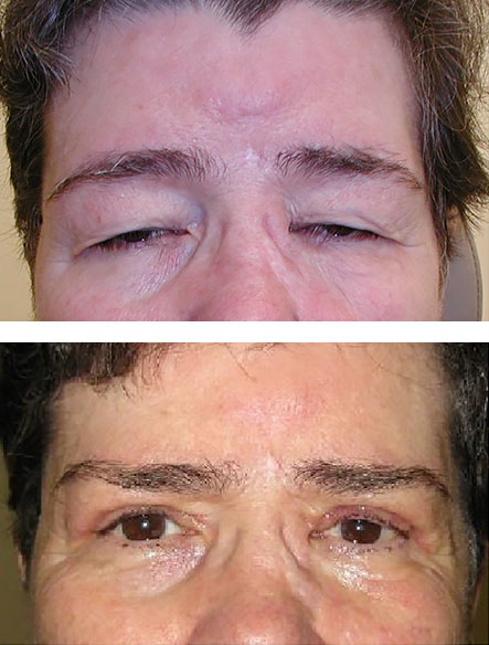 before and after blepharoplasty surgery in Charlottesville, VA
