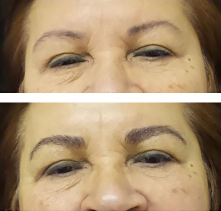 Widening the medial eyebrow and thickening with permanent makeup