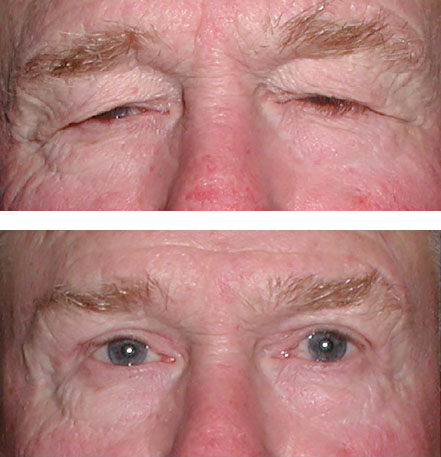 Direct brow lift before and after blepharoplasty