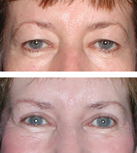 before and after blepharoplasty by Dr. Sara Kaltreider in Charlottesville, VA