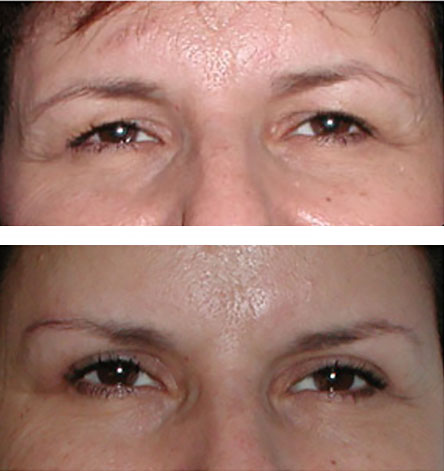 blepharoplasty surgery before and after photo - improved brow contour and eyelid levels