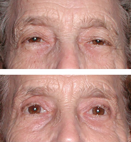 droopy eyelids open when the brows are lifted and the excess lid skin is removed with blepharoplasty brow lift surgery