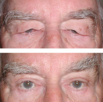 Down-sloping brows repaired after direct lateral brow lift blepharoplasty