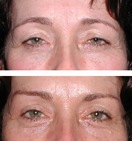 direct brow lift and blepharoplasty improve vision and appearance - before and after