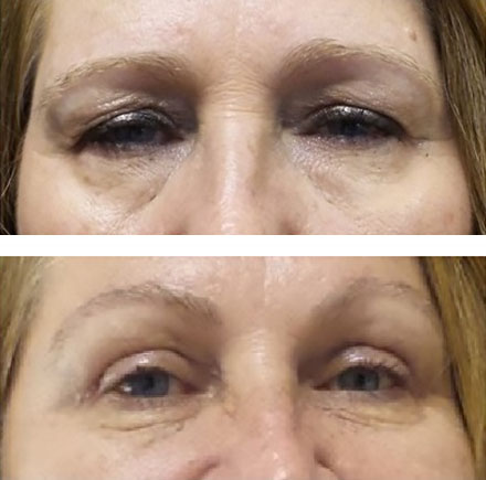 appearance improved with Down-sloping brows and more open eyelids are noted after direct lateral brow lift and blepharoplasty - before and after surgery photos