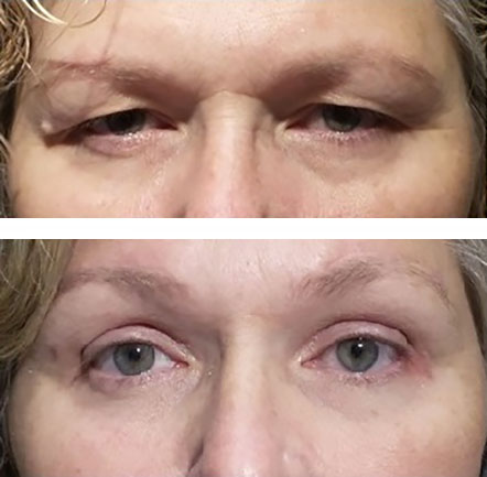 Tired, heavy eyelids improved after lifting the brows and removing skin in eyelid fold