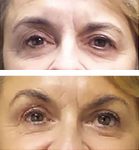 blepharoplasty, brow lift and MiXto CO2 laser resurfacing yield younger looking eyes and brow