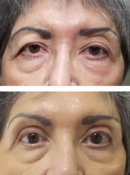 blepharoplasty and direct brow lift improve eyelid position