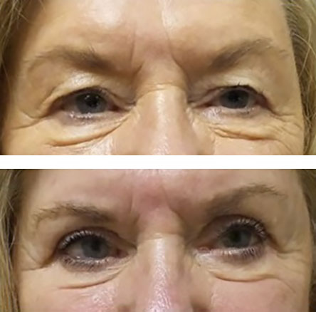 heavy looking brow improved after blepharoplasty and brow lift