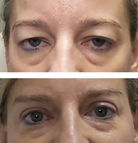 blepharoplasty opens eyes and lifts eyelids with brow lift - before and after pictures