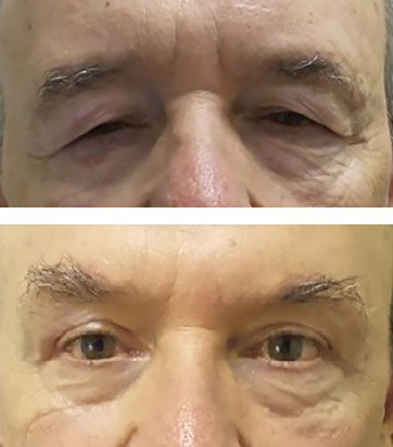 blepharoplasty and direct lateral brow lift open eyes and restore youthful look - before after photos